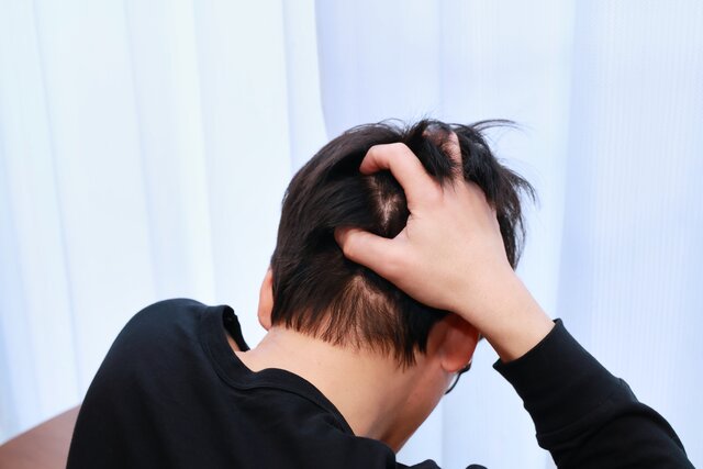 「円形脱毛症」患者の４分の１は15歳未満　“頭部に円形”だけではない【子どもの脱毛症】　毛の抜け方と治療方法とは［専門医が解説］
