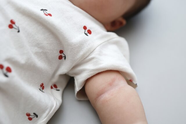 猛暑後の秋冬はリスク大！　乾燥の季節に続出する“乳児の肌トラブル”と正しいケア［医師監修］