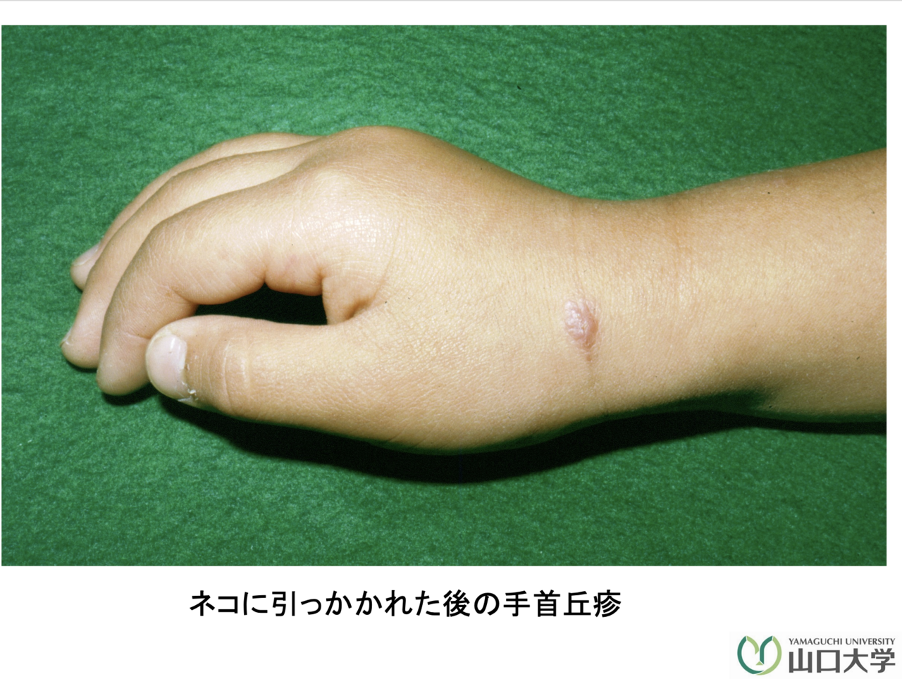 ▲原因菌に感染した猫にひっかかれたり、咬まれたりすることで引き起こされる （提供：山口大学　大学院医学系研究科　大津山 賢一郎講師）